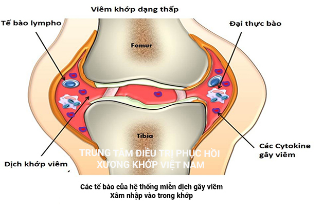 Viêm đa khớp dạng thấp