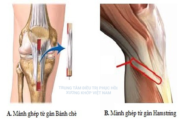  Viêm gân đầu gối