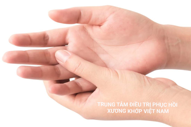 Viêm gân gấp ngón tay (Viêm gân lò xo)