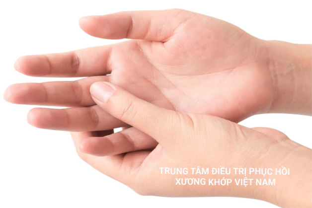 Viêm gân gấp ngón tay (Viêm gân lò xo) 