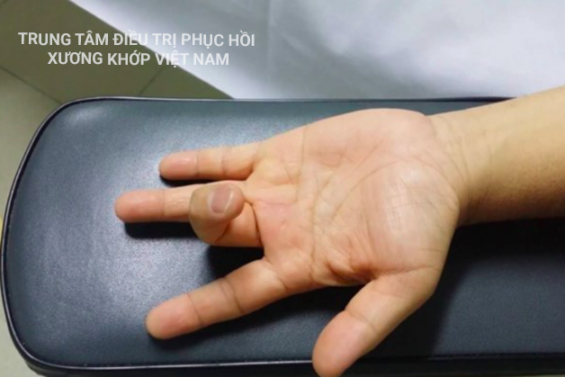 Viêm gân gấp ở bàn tay