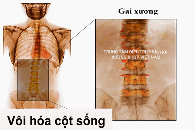 Vôi hóa cột sống