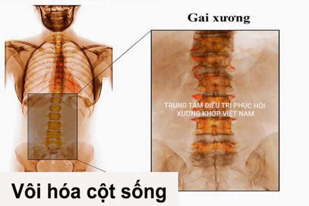 Vôi hóa cột sống