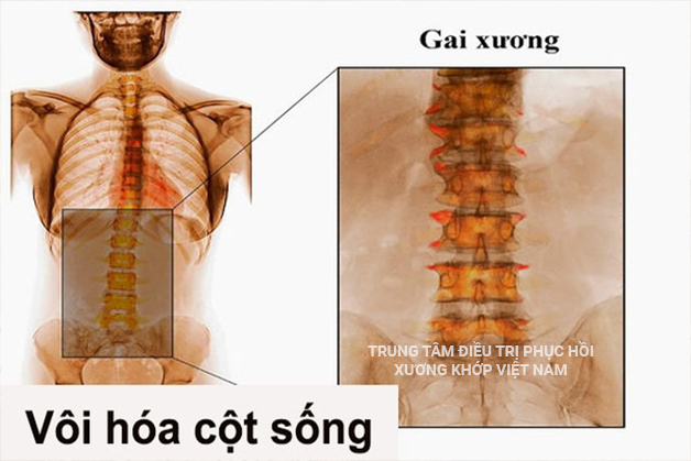 Vôi hóa cột sống, gai xương