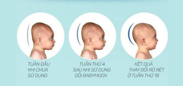 REVIEW gối chống bẹp đầu Babymoov thông tin vô cùng bổ ích cho các mẹ