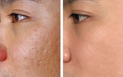 Cách sử dụng máy lăn kim Dr Pen