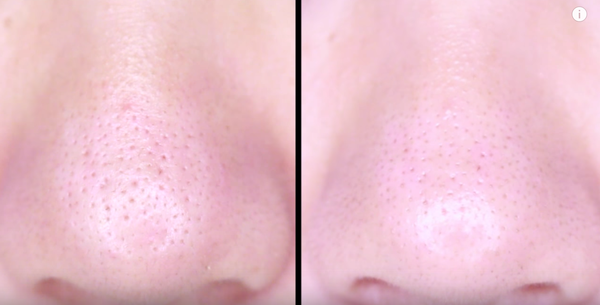 Cách làm sạch mụn đầu đen ở mũi