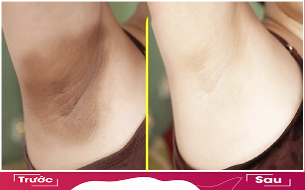 Spa Điều Trị Thâm Nách