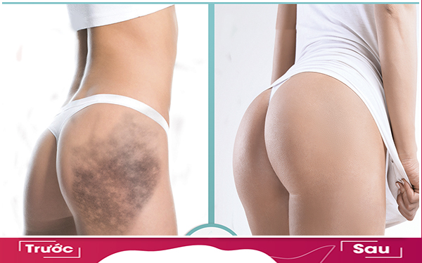 điều trị thâm mông