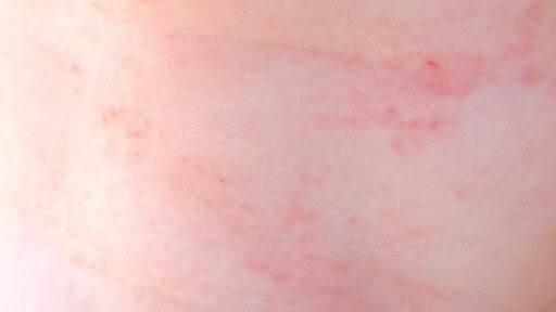 5 thắc mắc của cha mẹ về hăm tã được chuyên gia giải đáp