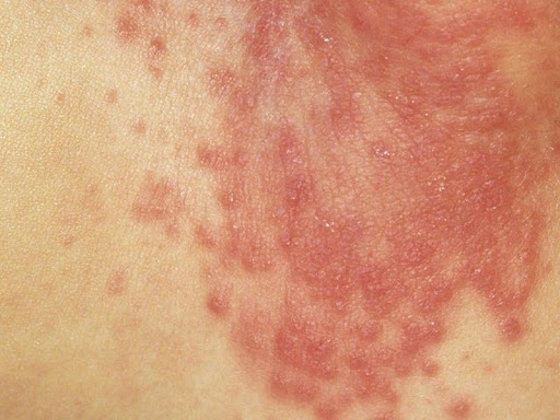 Xử trí như nào khi trẻ bị phát ban tã do nấm mem