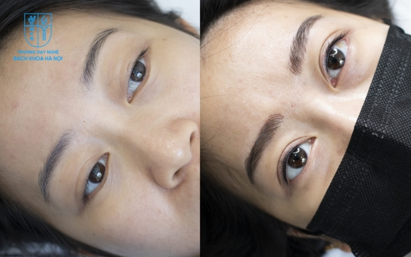 So sánh mắt trước và sau khi phun mí – rõ ràng, sắc nét hơn