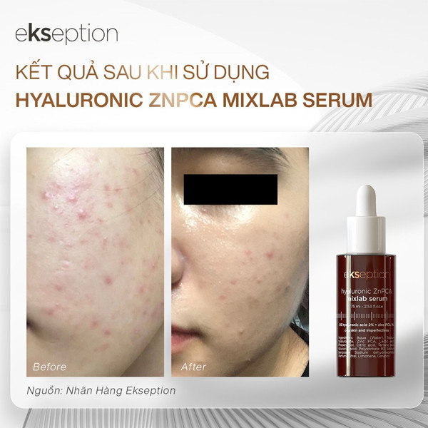 serum-kiem-dau-tri-mun-ekseption