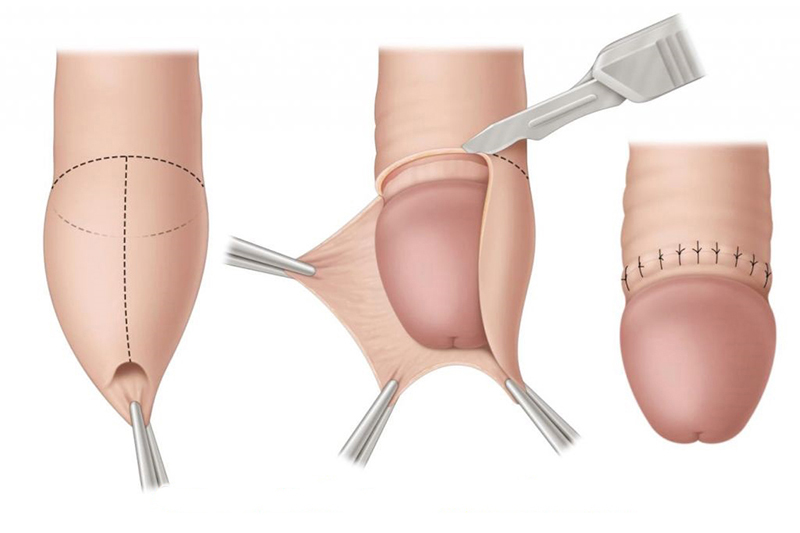 Chưa Lột Bao Quy Đầu Có Quan Hệ Được Không? Sự Thật Nam Giới Cần Biết