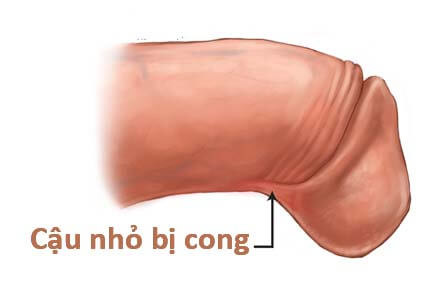 Dương Vật Cong Có Sao Không? Bí Mật Ít Ai Biết Về “Chiếc Chìa Khóa” Của Cánh Đàn Ông