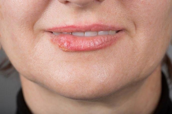 Bị Bệnh Herpes Có Nguy Hiểm Không? Dấu Hiệu Nhận Biết Và Cách Điều Trị Hiệu Quả