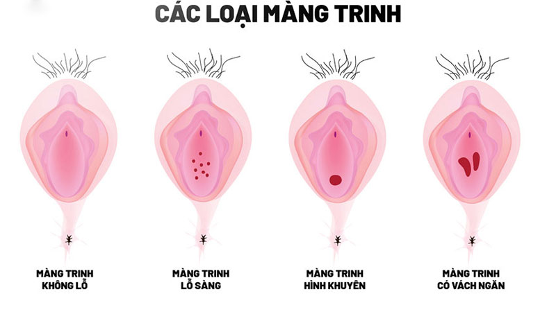 Lần Đầu Quan Hệ Không Ra Máu Có Phải Đã Mất Trinh Không?