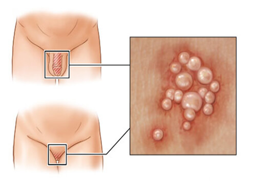 Mụn Rộp Sinh Dục Là Bệnh Gì? Dấu Hiệu, Nguyên Nhân Và Cách Điều Trị