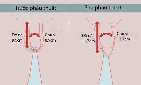 Phẫu thuật tăng kích thước dương vật: Những điều bạn cần lưu ý trước khi quyết định