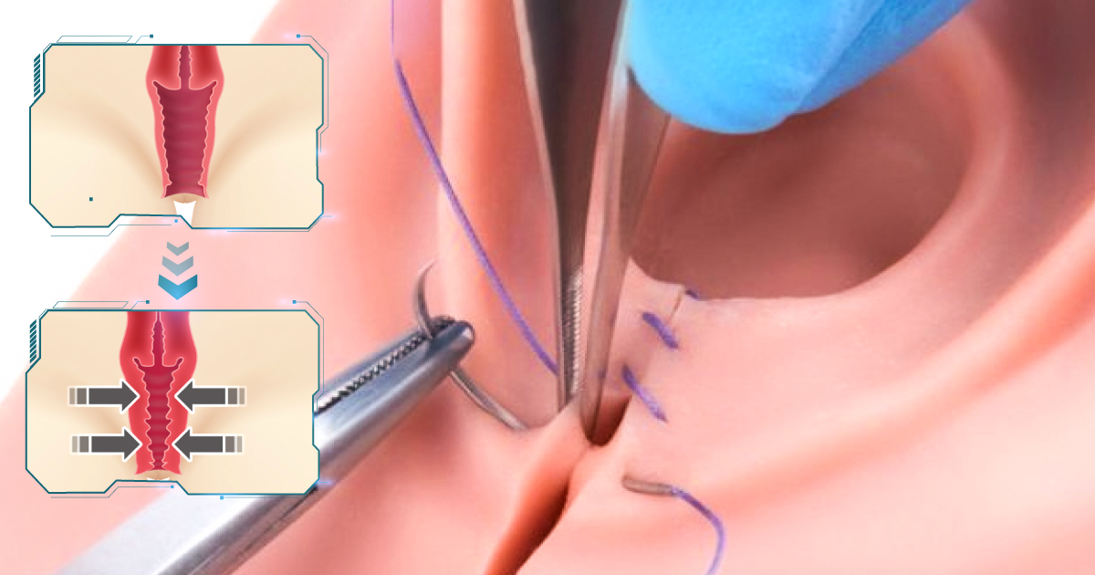Phẫu thuật thu nhỏ âm hộ nhưng điều nên biết mà lưu ý
