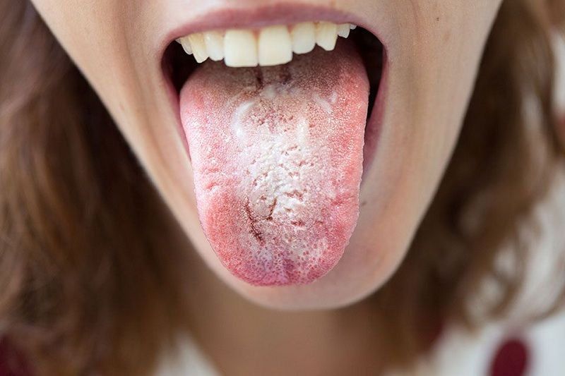 Quan Hệ Bằng Miệng Có Lây Nấm Candida Không? Cơ Chế Và Yếu Tố Tăng Nguy Cơ