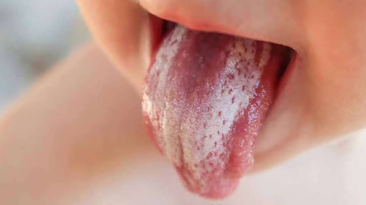 Quan Hệ Bằng Miệng Có Lây Nấm Candida Không? Cơ Chế Và Yếu Tố Tăng Nguy Cơ