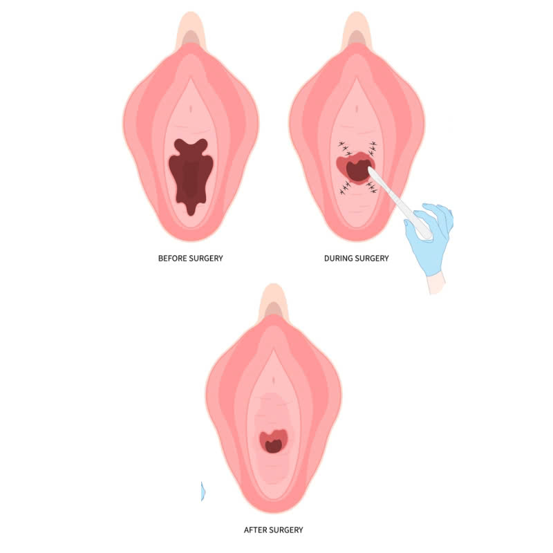 Phẫu Thuật Vá Màng Trinh: Có Phát Hiện Được Không Và Có Nguy Hiểm Không?
