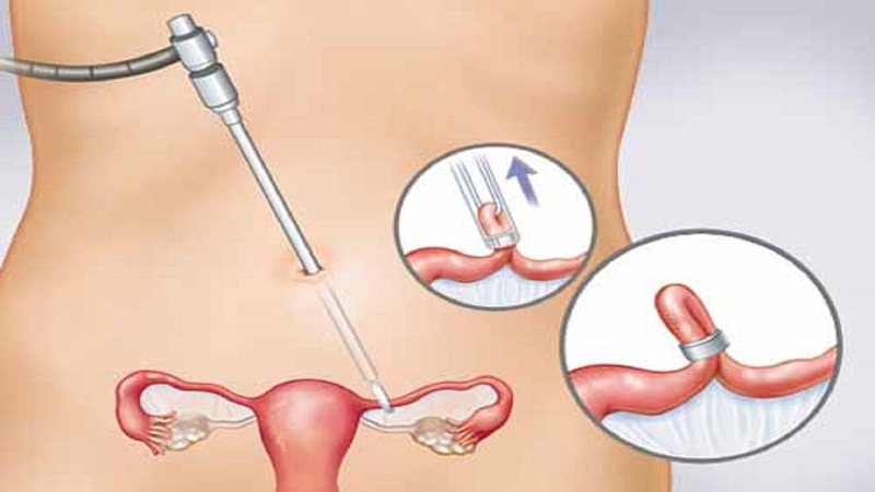 Thắt Ống Dẫn Trứng Là Gì? Lợi Ích, Rủi Ro Và Những Lưu Ý Quan Trọng