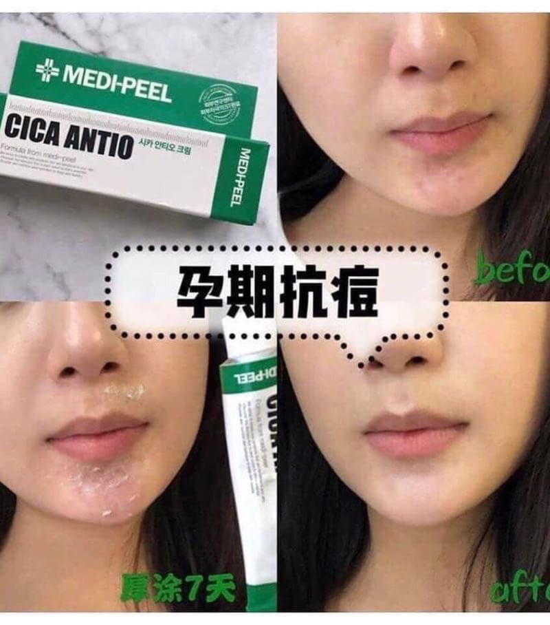 Kem Trắng Da Giảm Mụn Medi Peel Cica Antio Cream 30ml