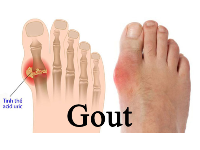 Người bệnh gout thường khởi phát đầu tiên ở ngón chân cái