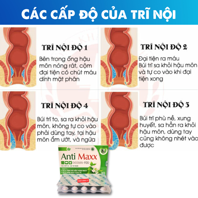 Các cấp độ trĩ nội