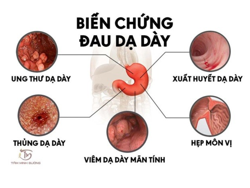 Tác hại và biến chứng của bệnh trào ngược dạ dày