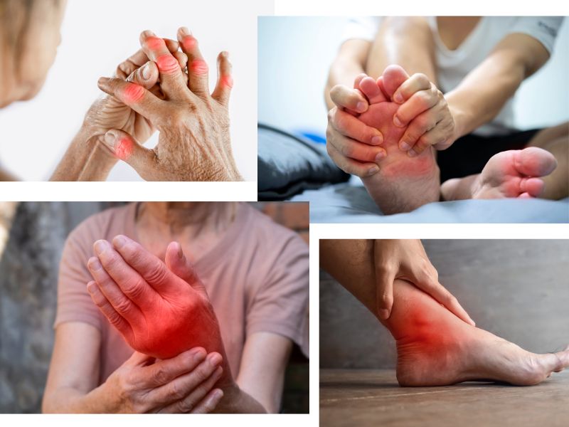 Tìm hiểu về bệnh gout