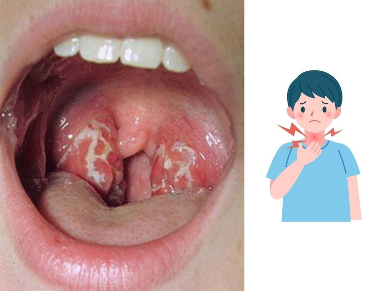 Nguyên nhân và dấu hiệu nhận biết bệnh bạch hầu