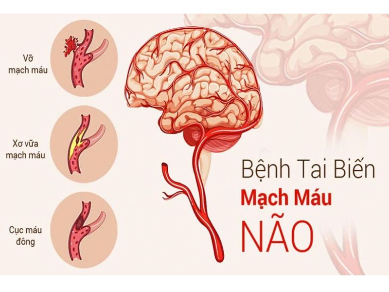 Bệnh xơ vữa động mạch