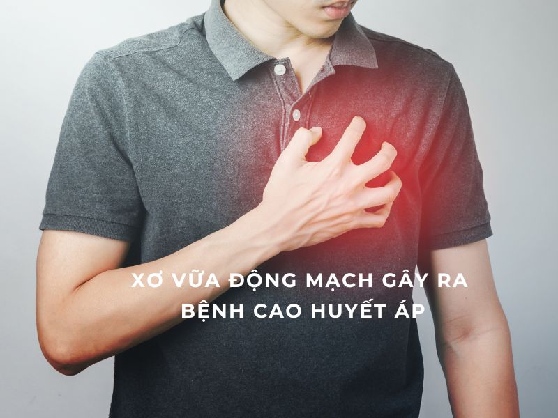 Xơ vữa động mạch gây ra tình trạng cao huyết áp