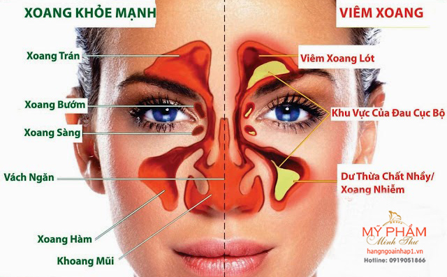 Viên uống đặc trị viêm xoang Kobayashi Chikunain - Nhật Bản