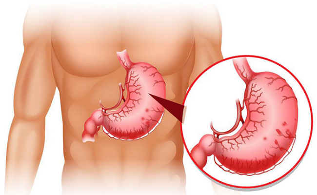 Cấy chỉ đã được chứng minh là có hiệu quả trong việc điều trị nhiều loại bệnh, trong đó có các bệnh liên quan đến dạ dày.