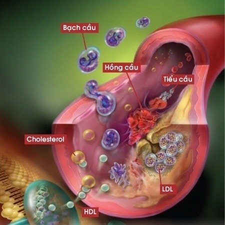 Rối loạn chuyển hóa lipid máu