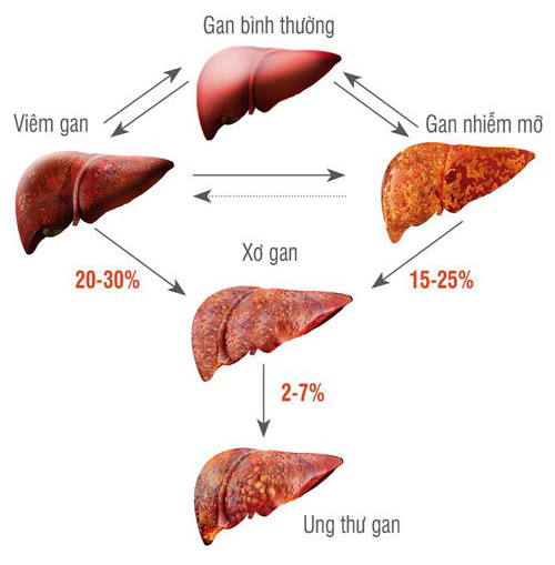 Tiến triển của bệnh gan qua các giai đoạn