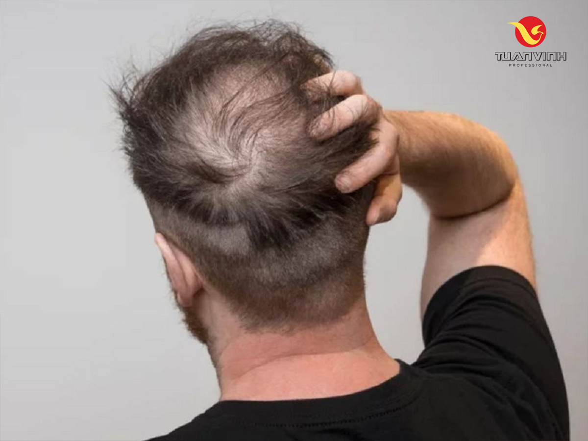 Một số dòng gôm tạo kiểu gây ra mỏng và rụng tóc