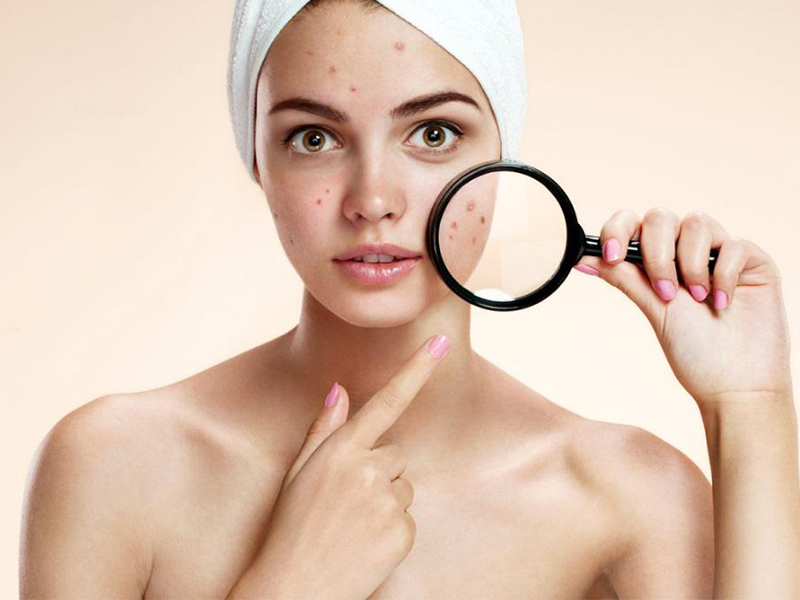Các bước SkinCare cho da mụn đúng cách và dễ dàng Các bước SkinCare cho da mụn đúng cách và dễ dàng
