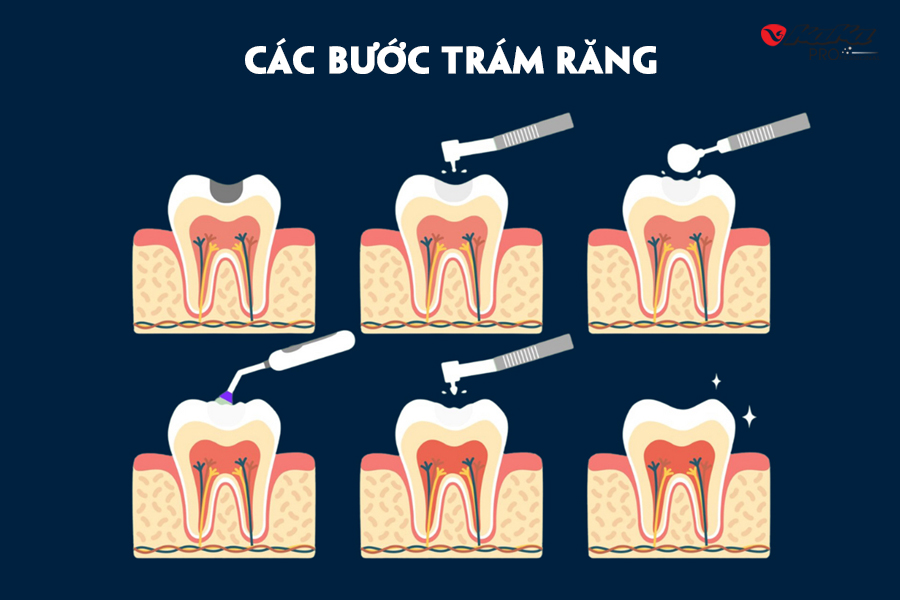 Các bước trám răng chuẩn y khoa
