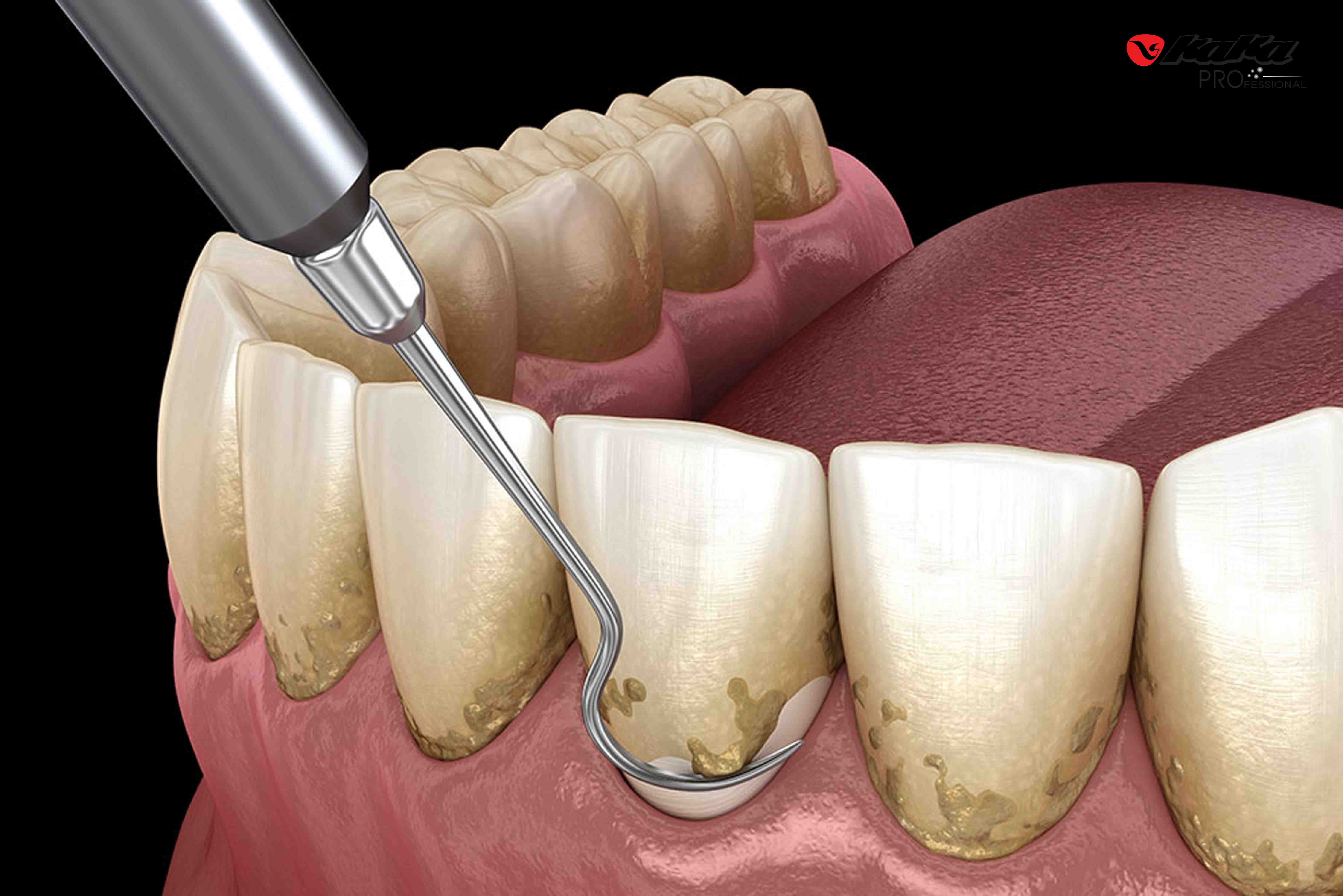 Cạo vôi răng định kì giúp ngăn chăn viêm nướu răng