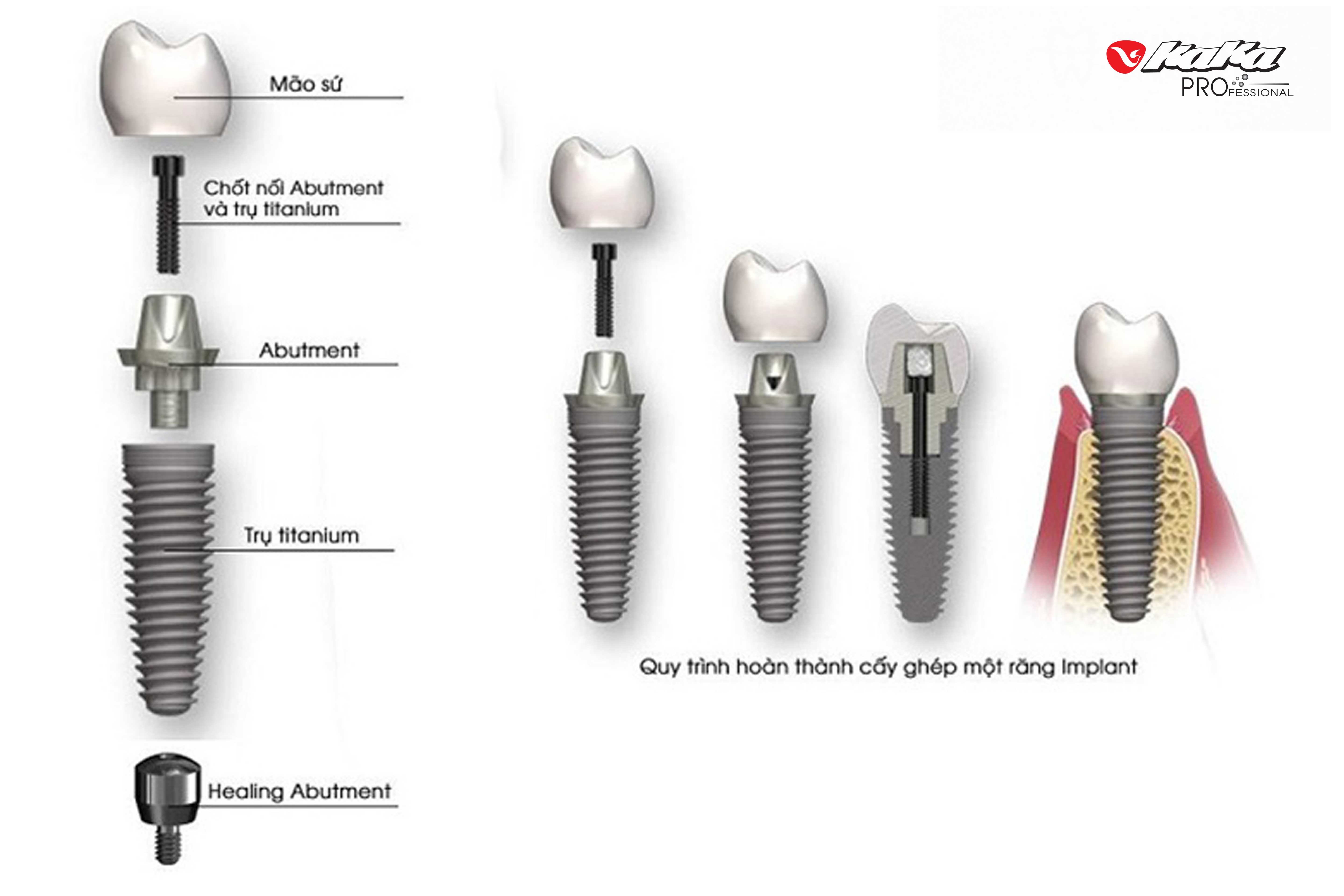 Cấu tạo trụ implant