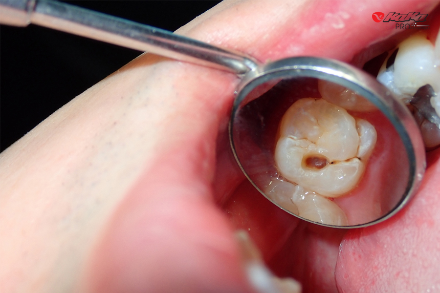 Giai đoạn đầu khi răng bị sâu