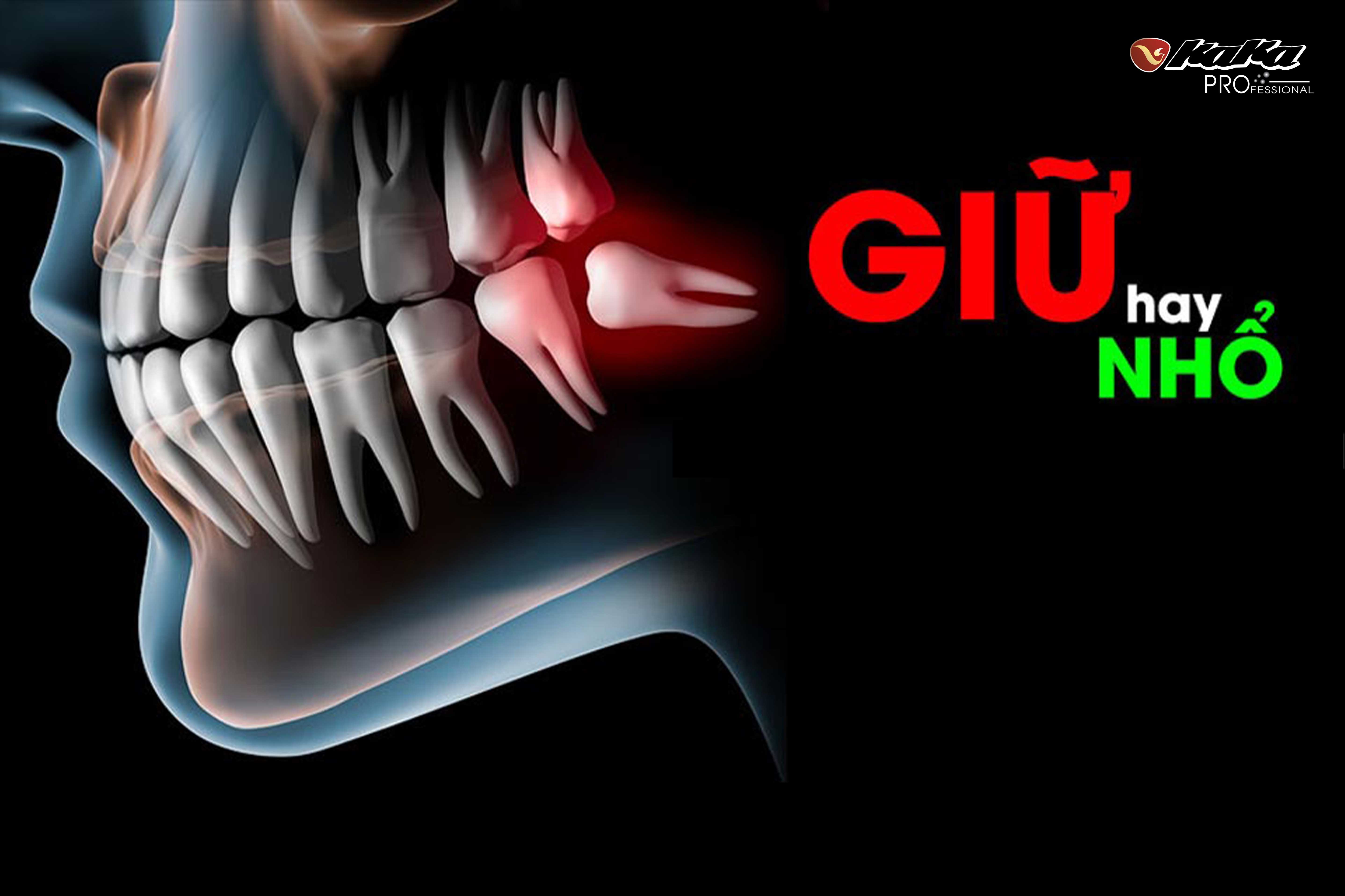 Nên giữ hay nhổ răng khôn?