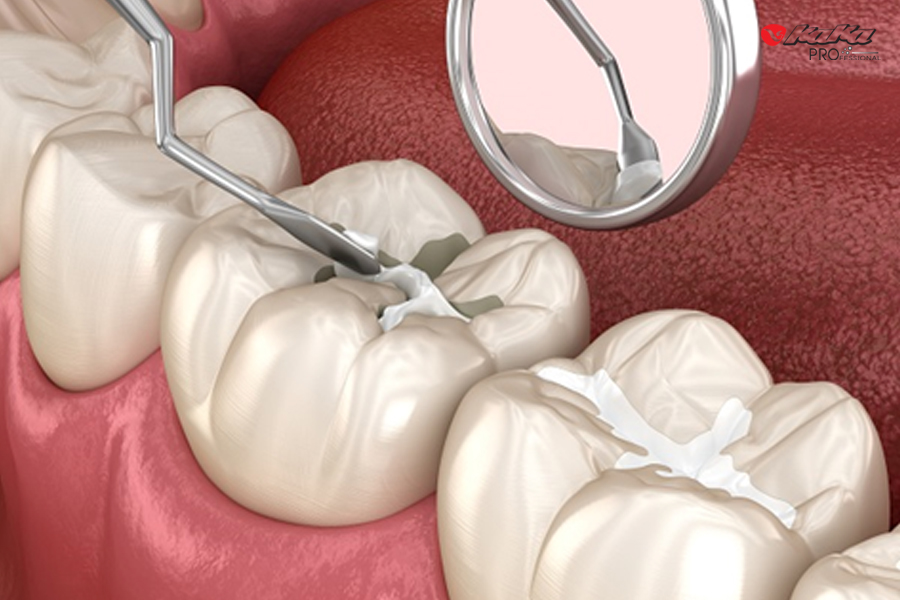 Phương pháp trám răng với chất liệu GIC