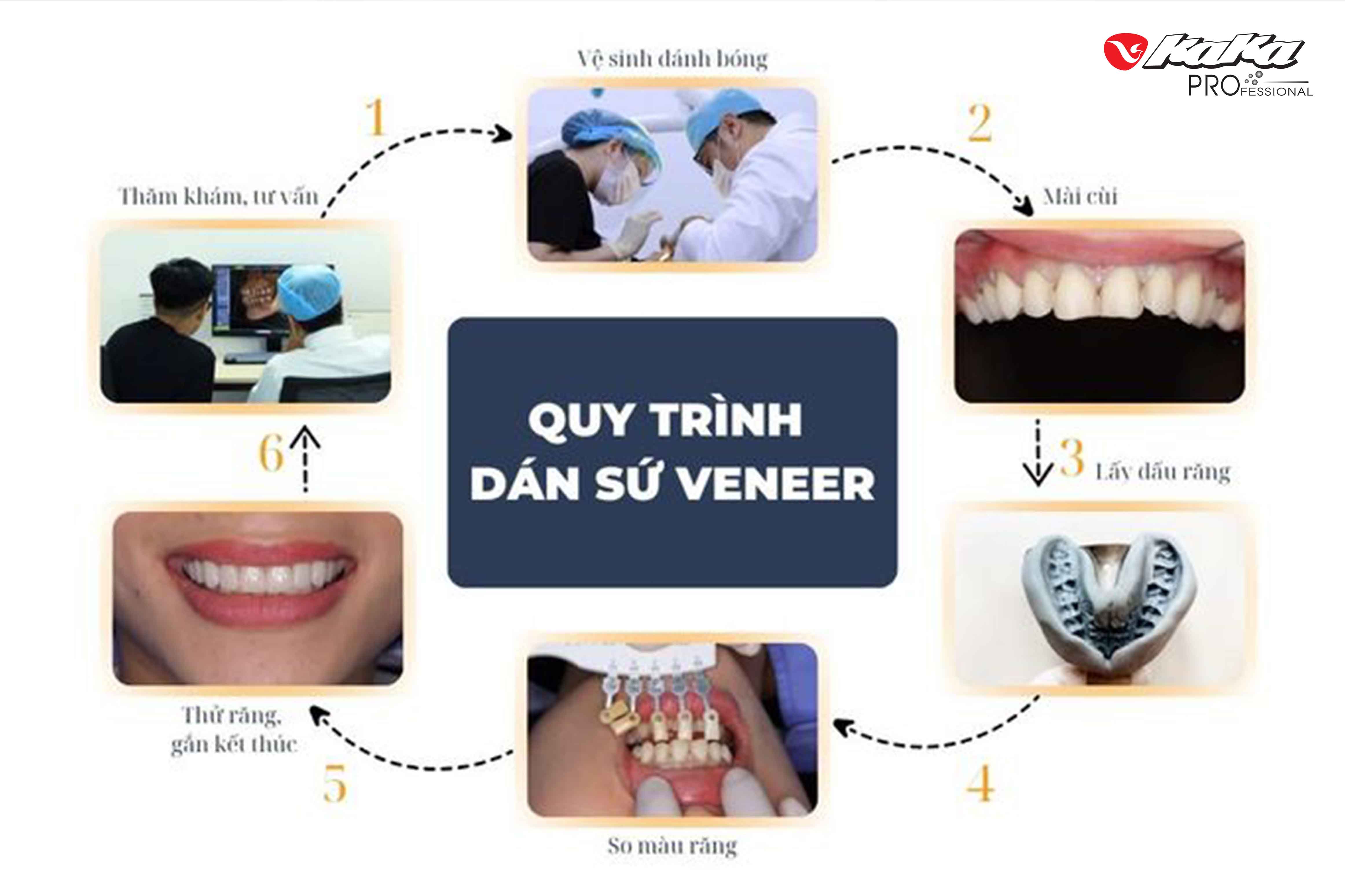 Quy trình dán răng sứ Veneer