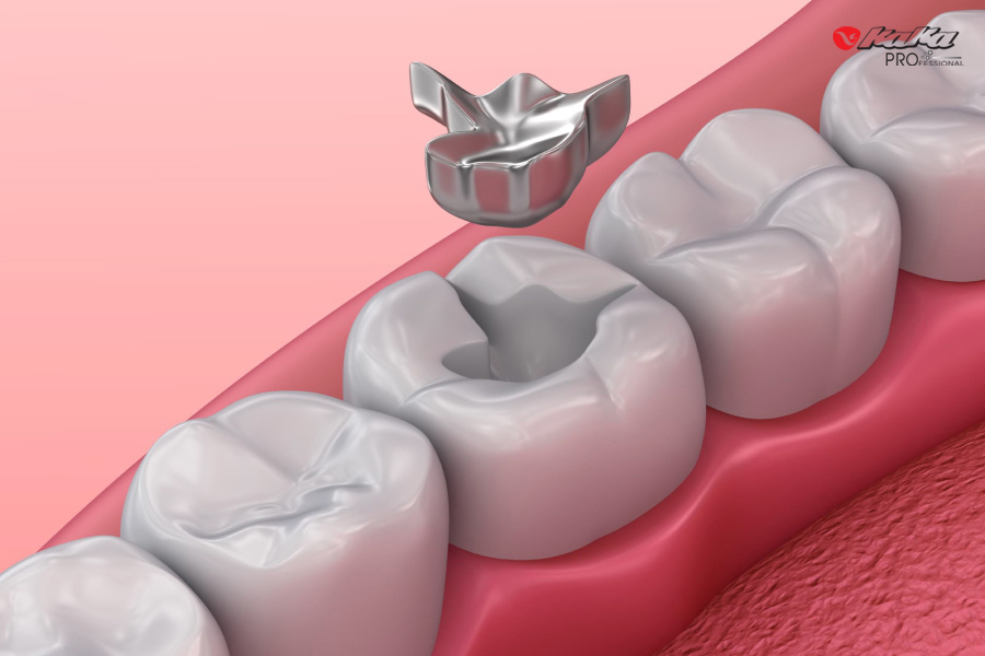 Trám răng bằng Amalgam